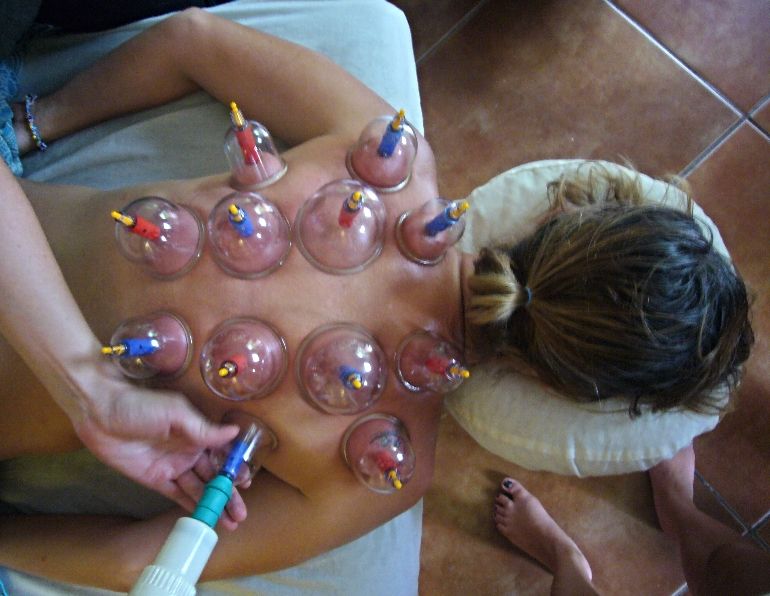 Cupping with Jessica Lusk Massage Therapy